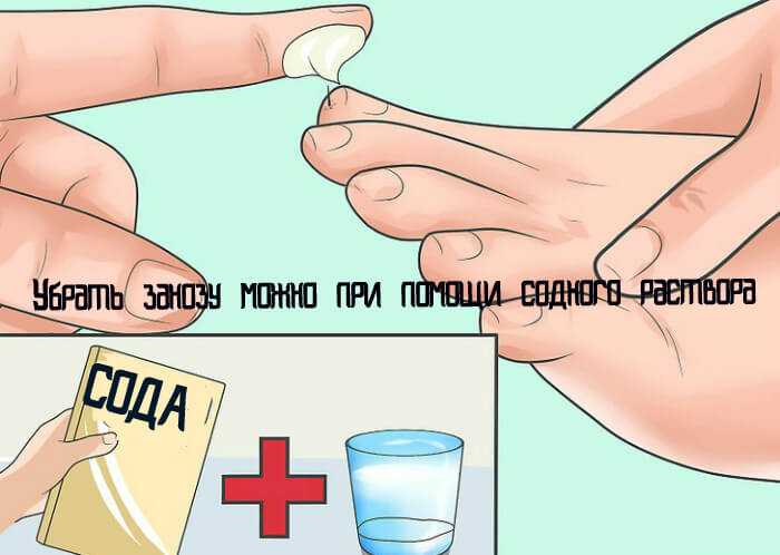 Как вытащить занозу из-под ногтя быстро, без боли, с помощью народных средств