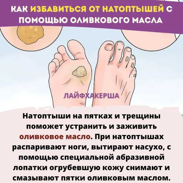 Аспирин от натоптышей на ногах: рецепты эффективных средств